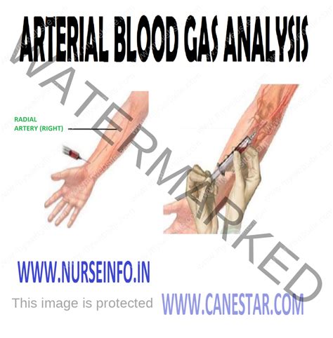 gas analyzer drawing|Arterial Blood Gas (ABG) .